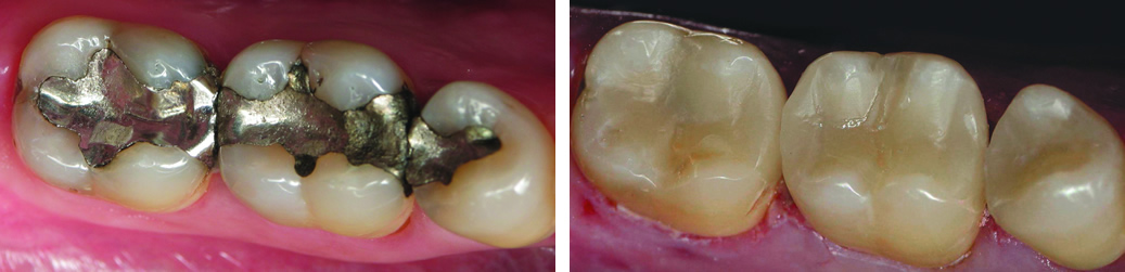 Same-Day Tooth Restoration