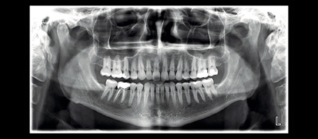 Digital X-Rays